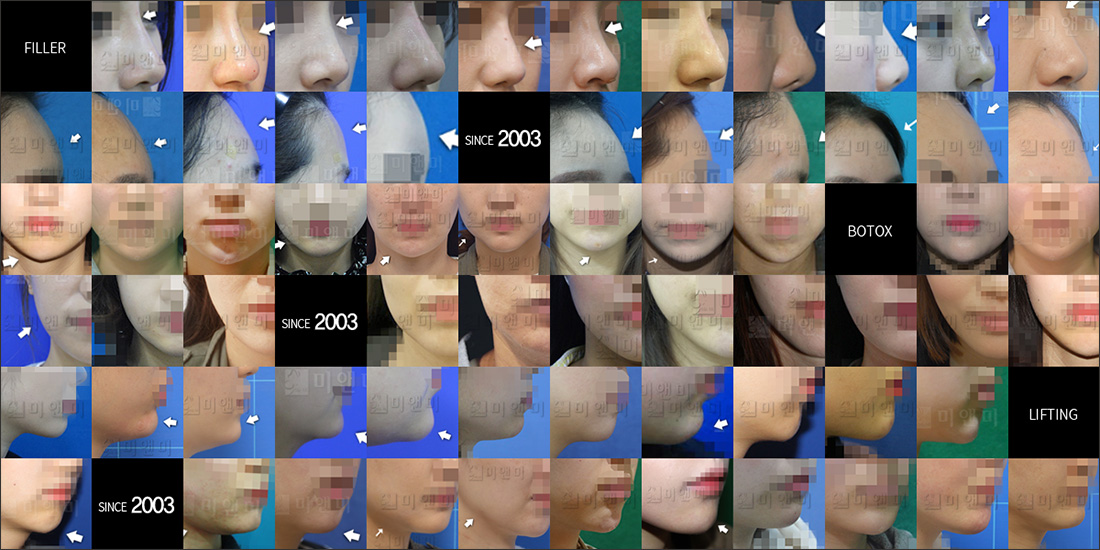 SINCE 2003 MI&MI, 시술후사진모음 강서모공, 발산역모공